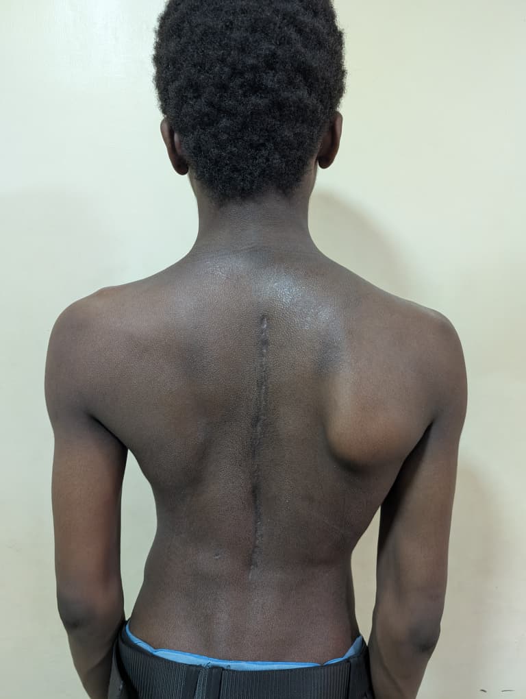 After: Posterior Spinal Fusion for Scoliosis